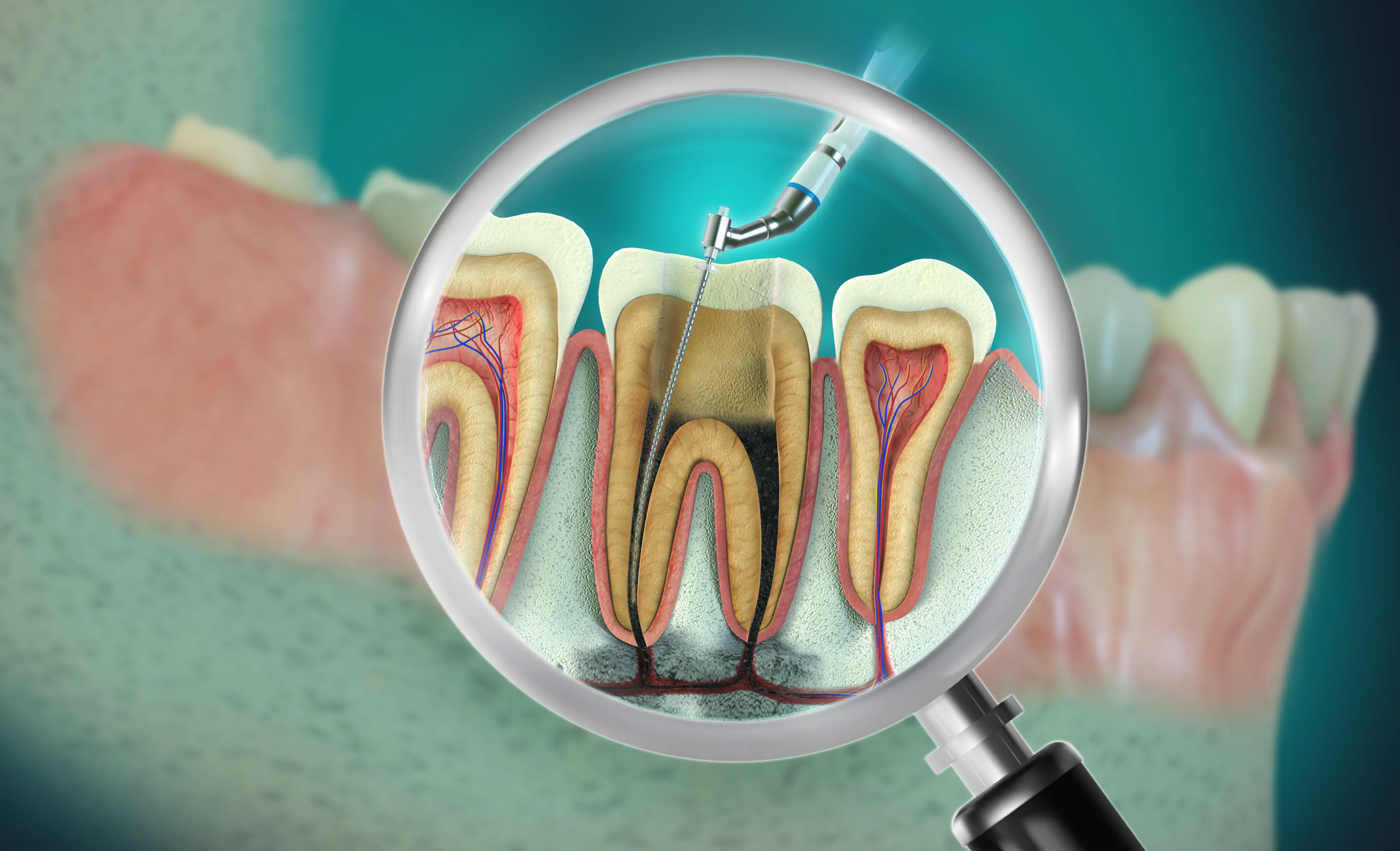 Root Canal Therapy
